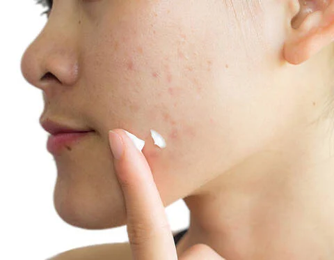 how-to-get-rid-of-pimples-overnight-acne-spot-treatment